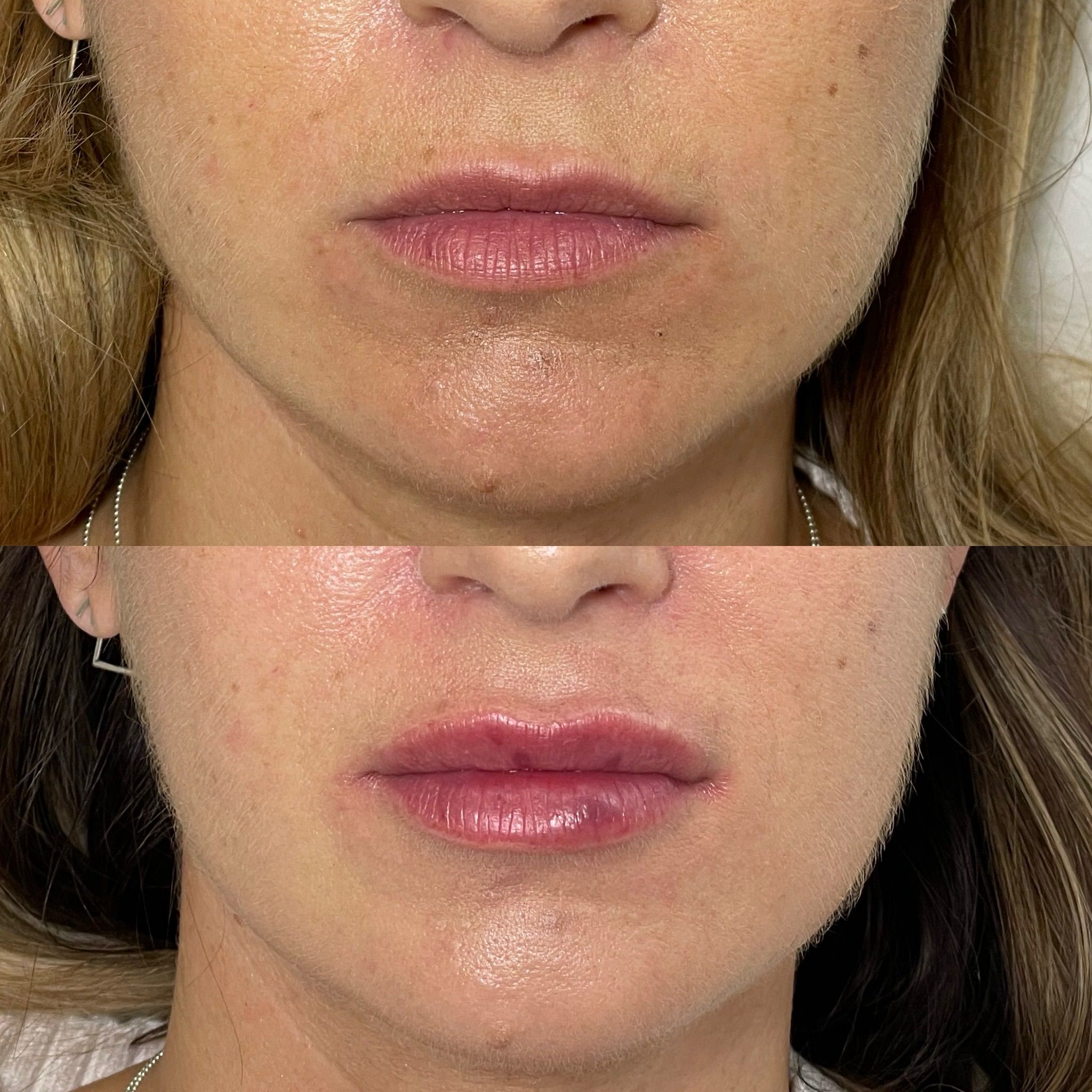 Lip Filler London | Natural Lip Enhancement in Knightsbridge