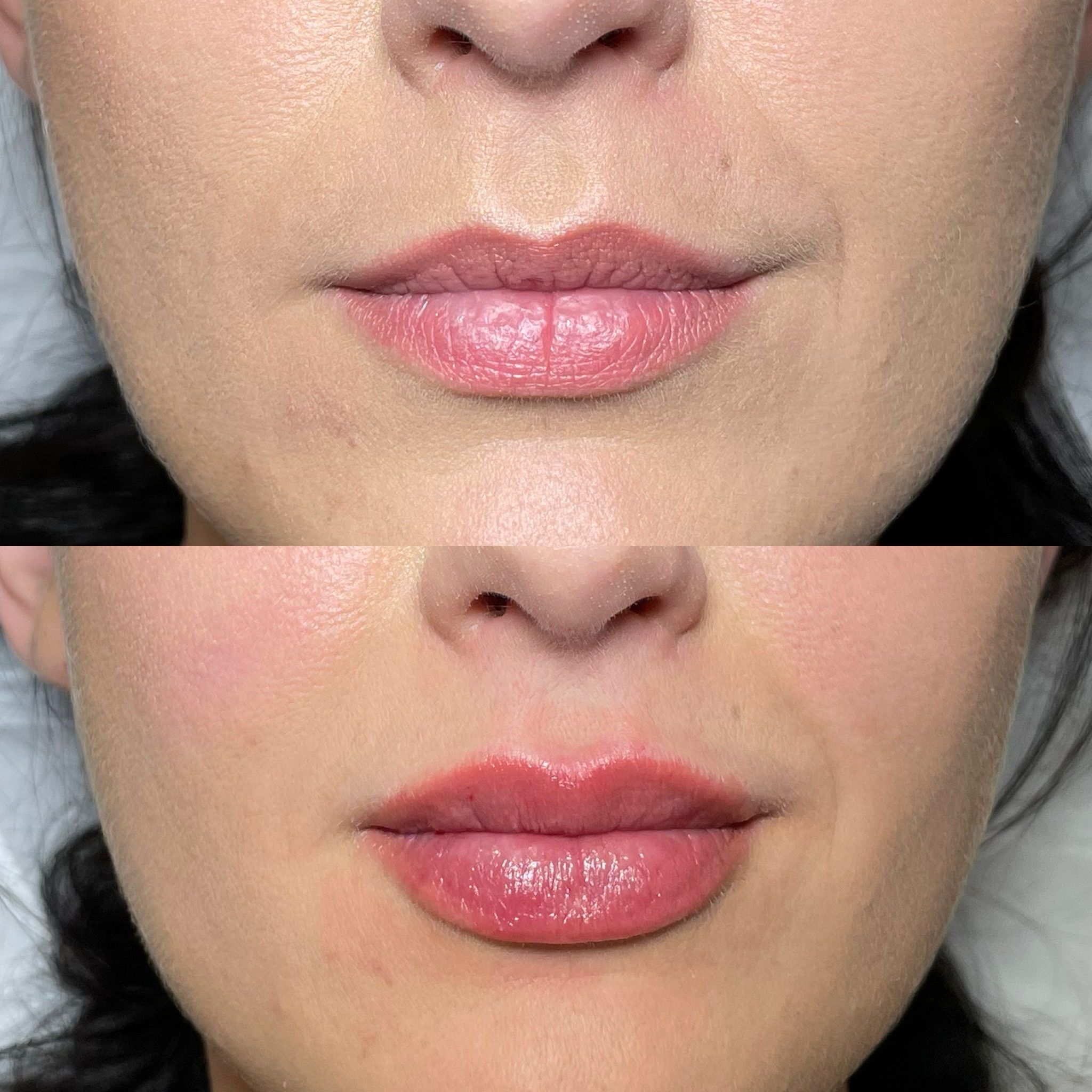 Lip Filler in London: Natural Lip Enhancement with Quiet Confidence