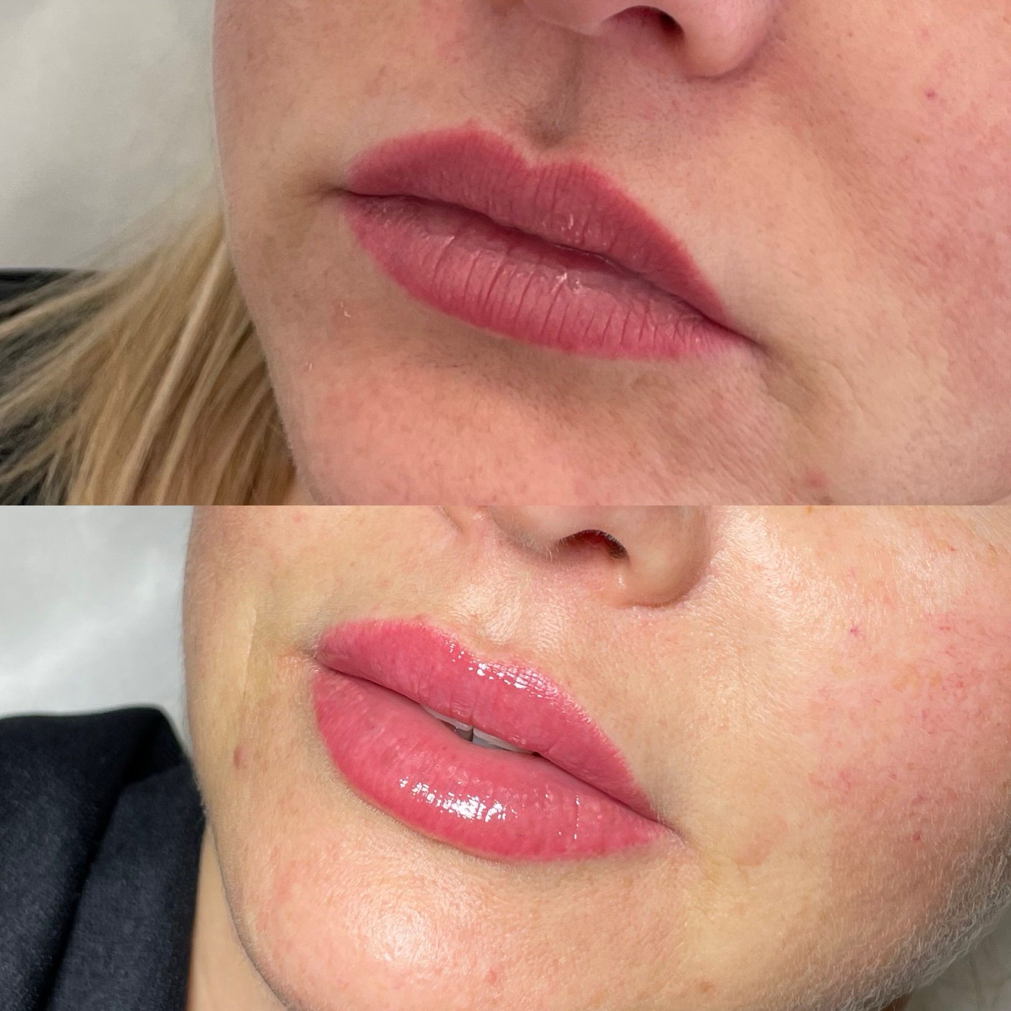 Lip Filler London | Natural Lip Enhancement in Knightsbridge