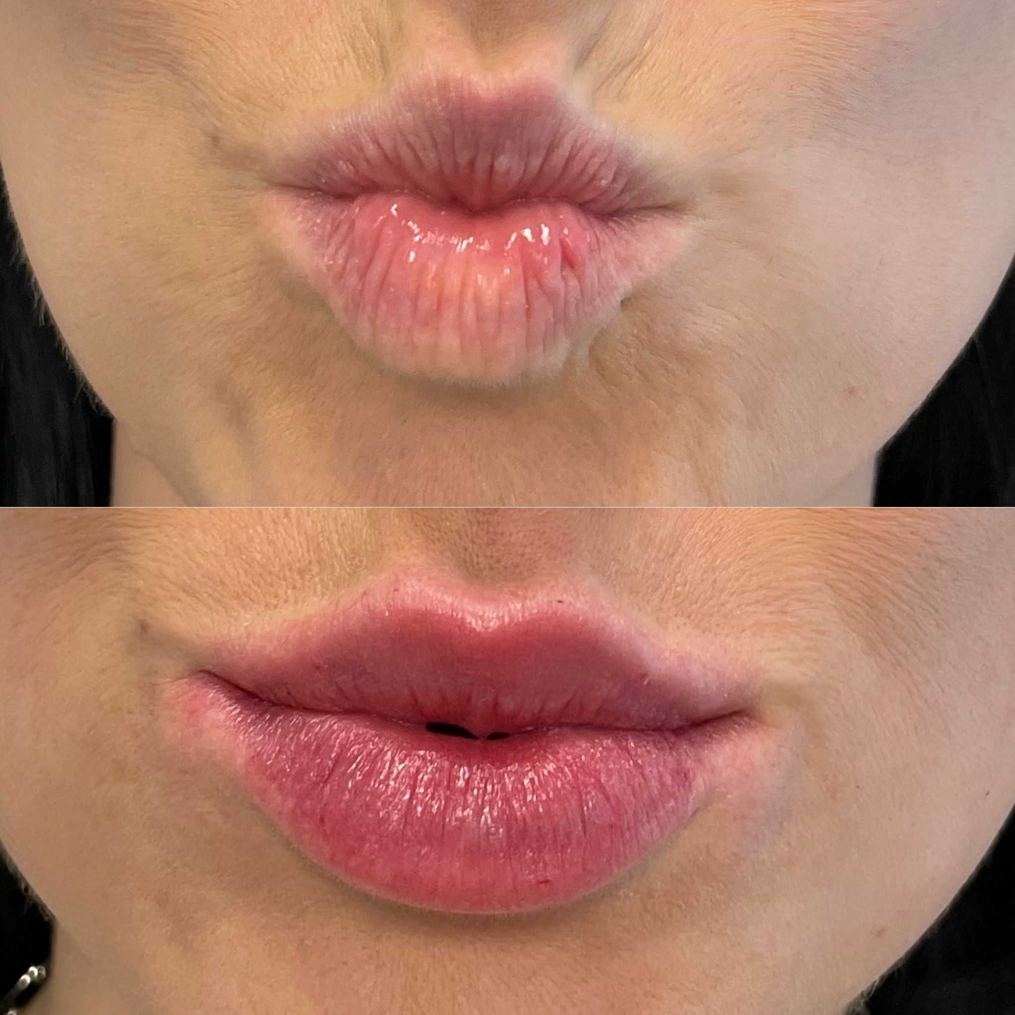 Lip Filler London | Natural Lip Enhancement in Knightsbridge